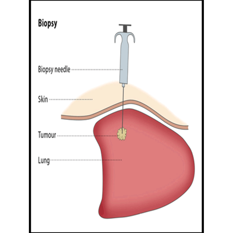 BIOPSY PKLI&RC