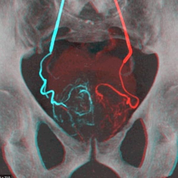 EMBOLISATION OF THE PROSTATIC ARTERIES - PKLI&RC