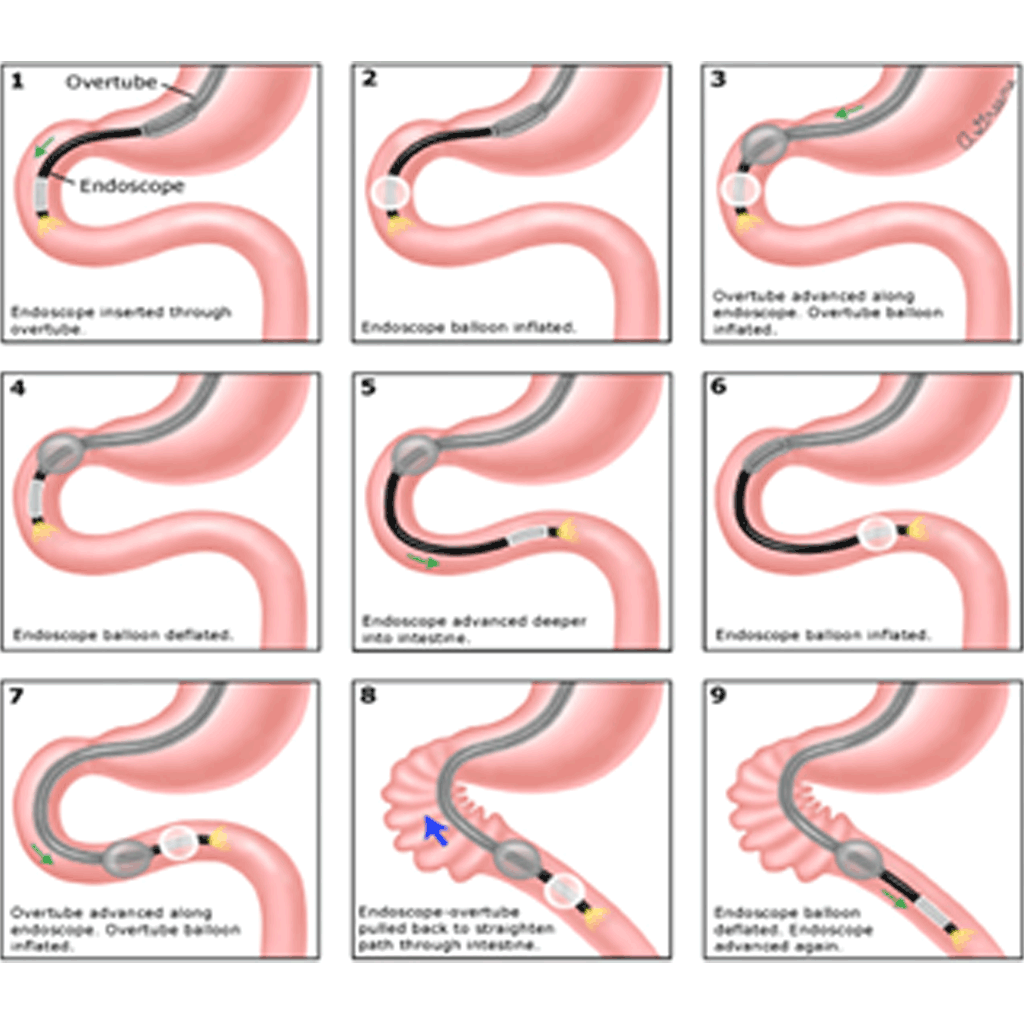 INTERVENTIONAL ENDOSCOPY PKLI&RC