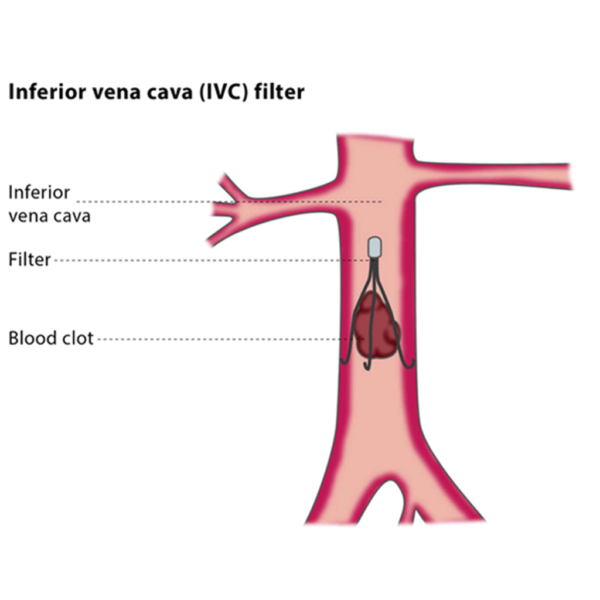 INFERIOR VENA CAVA (IVC) FILTERS PLACEMENT AND RETRIEVAL - PKLI&RC