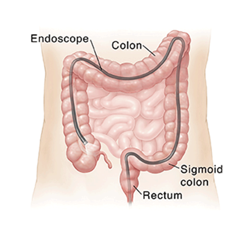 INTERVENTIONAL ENDOSCOPY PKLI&RC