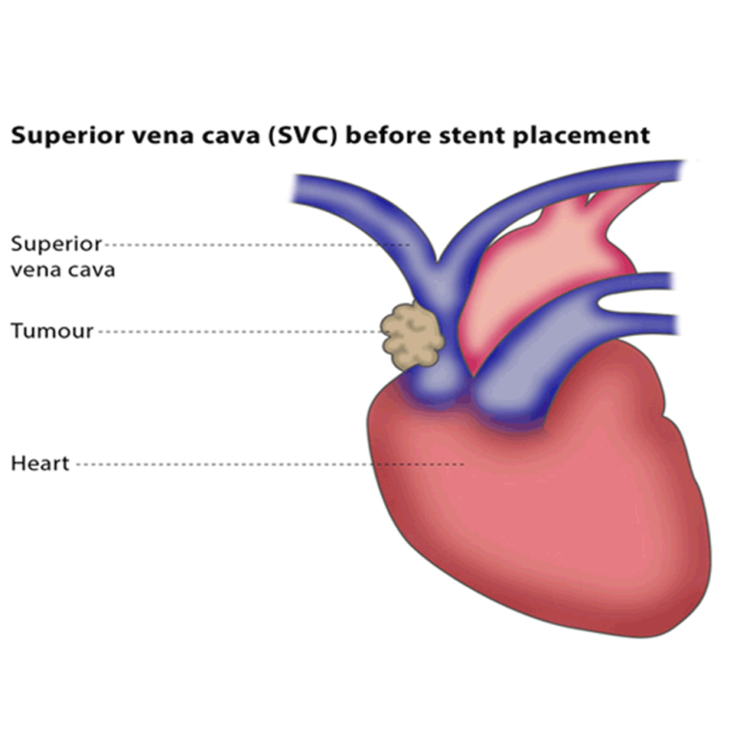 VENA CAVA STENTING - PKLI&RC