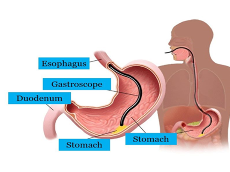 INTERVENTIONAL ENDOSCOPY PKLI&RC
